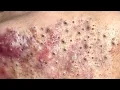 Loan Nguyen Acne Treatment