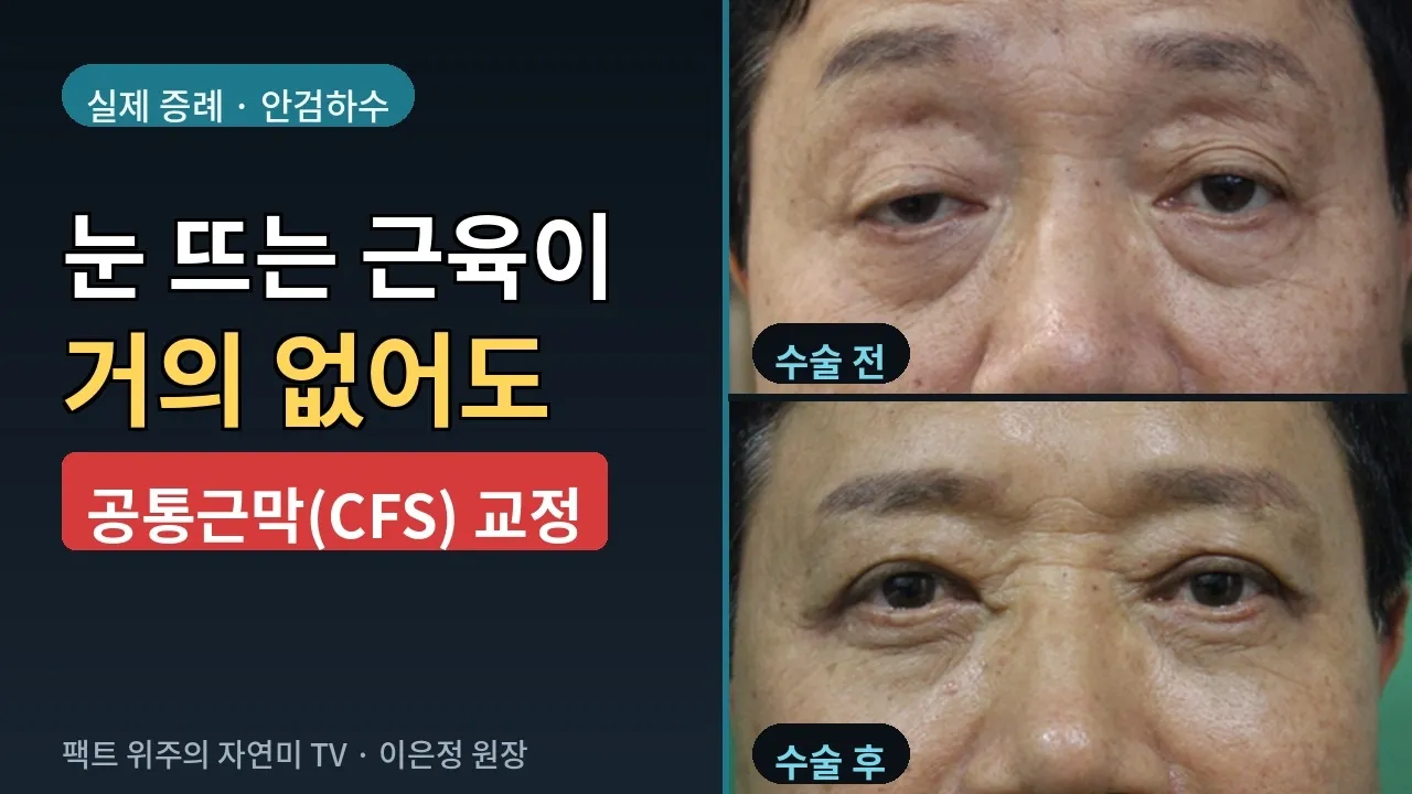 **눈 뜨는 근육이 없어도 눈을 뜹니다 | 공통근막(CFS) 안검하수 교정**  #공통근막 #안검하수 #거근단축술 #뮬러근 #연세자연미