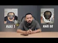 Download Lagu Cara Menumbuhkan Rambut Yang Kebotakan! 100% BERHASIL Kalau…