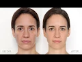 Download Lagu Clear + Brilliant® Permea Laser with Dr. Anne Chapas, Elle Magazine \