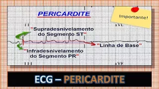 ECG - Eletrocardiograma com Pericardite