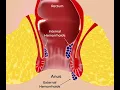 Hemorrhoids Piles Thrombosed Pectinate line Sphincteroplasty - Dr Rams Medical Coding Academy