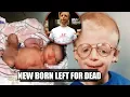 How parent abandoned Jonathan Lancaster 36 hours for having scary disease treacher Collins syndrome