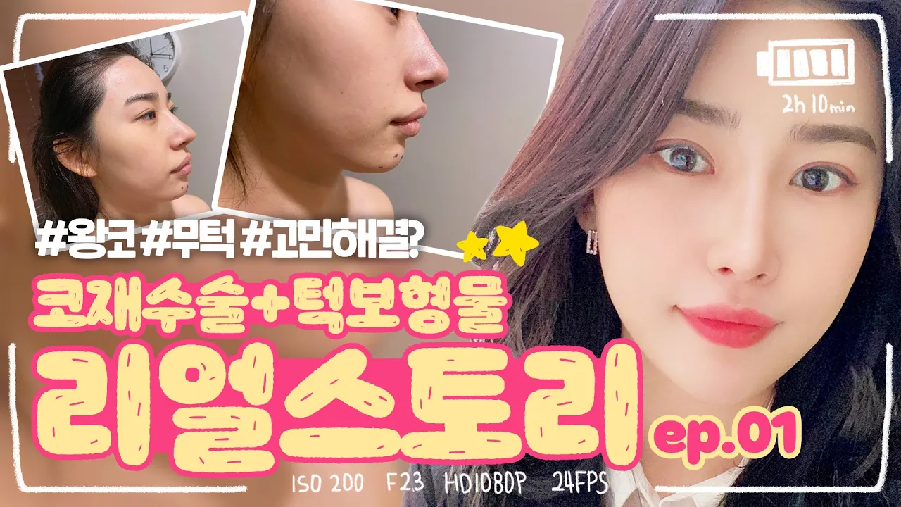 큰코와 짧은얼굴을 좀더 슬림하고 균형있게!! 코 재수술+턱 보형물 브이로그 수술후기! 1탄 ㅣ압구정 디엠성형외과
