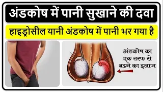 हाइड्रोसील का रामबाण इलाज