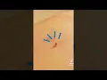 VIRAL TikTok Skin tag remover Amazon must haves TagBand