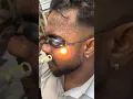 Download Lagu # skin whitening laser treatment # spots treatment #permanent #glowingskin #laser #shrots 9910549389