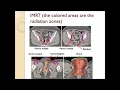 Download Lagu Cancer of the Vulva