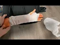 Splinting Unstable Forearm Injuries
