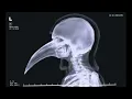 Real SCP - 049