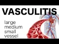 Vasculitis