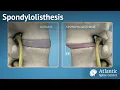 Spondylolisthesis