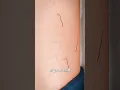 What s Inside A Pilonidal Cyst