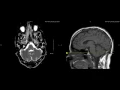 Unremarkable Non-Contrast Brain MRI Axial ADC - Example 1