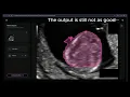 Meta SAM 3 vs Auta AI Medical Image Segmentation Showdown