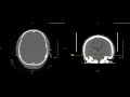 Unremarkable Non-Contrast CT Axial Bone Window-Example 3