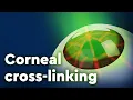 Corneal Collagen Cross-linking and Keratoconus Treatment
