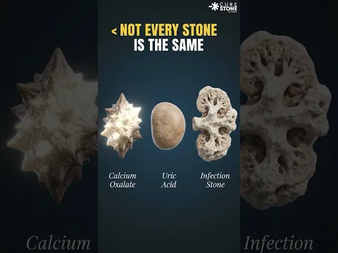 Why kidney stones form again and again #urology