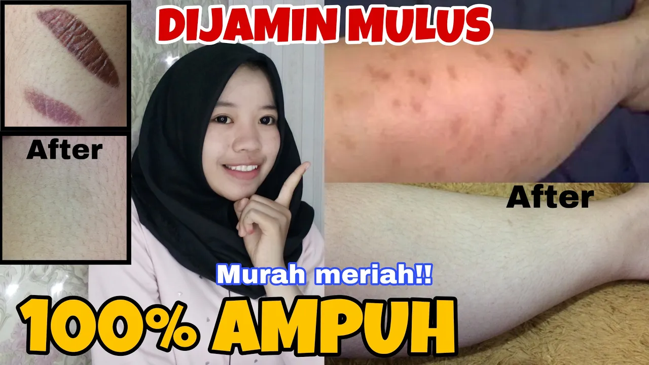 Terimakasih sudah menonton Ini video tentang pengalaman aku sendiri untuk mencoba treatment LASER BE. 