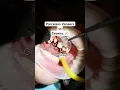 Porcelain Veneers vs Crowns What s the difference