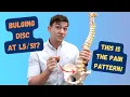 Download Lagu L5-S1 Bulging Disc Pain Pattern Explained!