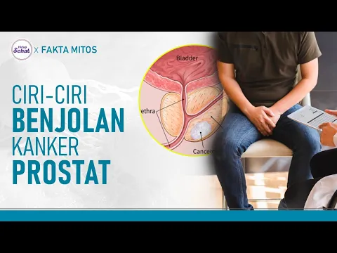 Pria Waspada! Raba dan Rasakan Benjolan Tanda Kanker Prostat