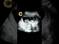 What happens to a baby when a pregnant woman laughs