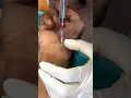 ABG technique Radial artery #norcet #nursing #knowledge #medical #abg