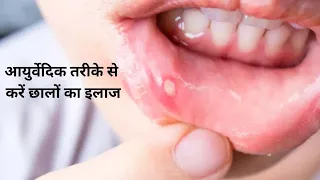 मुंह में छाले होने पर इस्तेमाल करें मुलेठी | Mulethi Benefits For Ulcer | जानें तरीका और फायदे
