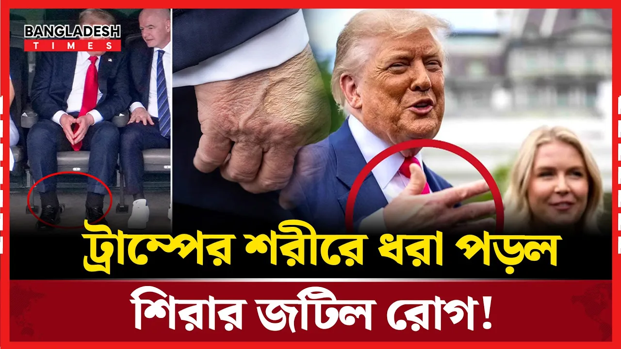 ‘ক্রনিক ভেনাস ইনসাফিসিয়েন্সি’ রোগে আক্রান্ত ট্রাম্প