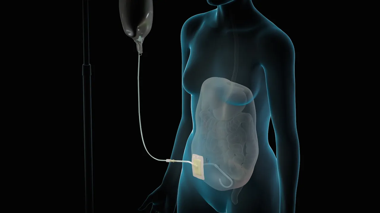 Outline Video Dialysis | Nucleus Health