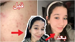 التخلص من الحبوب في اقل من 3 ايام أقوي ماسك للحبوب وأثار الحبوب والتصبغات تجهيزات العيد 