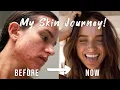 Download Lagu MY BIGGEST INSECURITY | My acne story