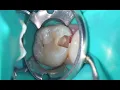 Direct pulp capping with Bright MTA Capping (Prof.Duck-Su Kim)