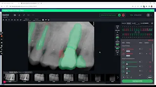 Dentrix Ascend Auto Charting Detect Denti AI