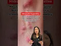 Hidradenitis Suppurativa HS