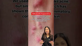 Hidradenitis Suppurativa HS