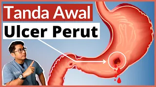 Download Ulcer Perut | Gastrik \u0026 Angin | 5 Tanda Awal Wajib Tahu | Doctor Sani | MP3