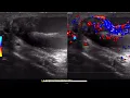 Testicular Torsion with and without flow