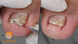 Comfort and smoothness returns when walking. Cleaning toenails & all the accumulated skin | Podology
