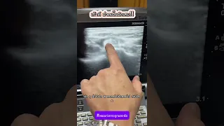  เก๊าทเกิดจากอะไร และมีอาการอย่างไรบ้าง 