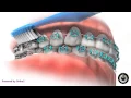 How to Brush Your Teeth with Braces - Markham ON
