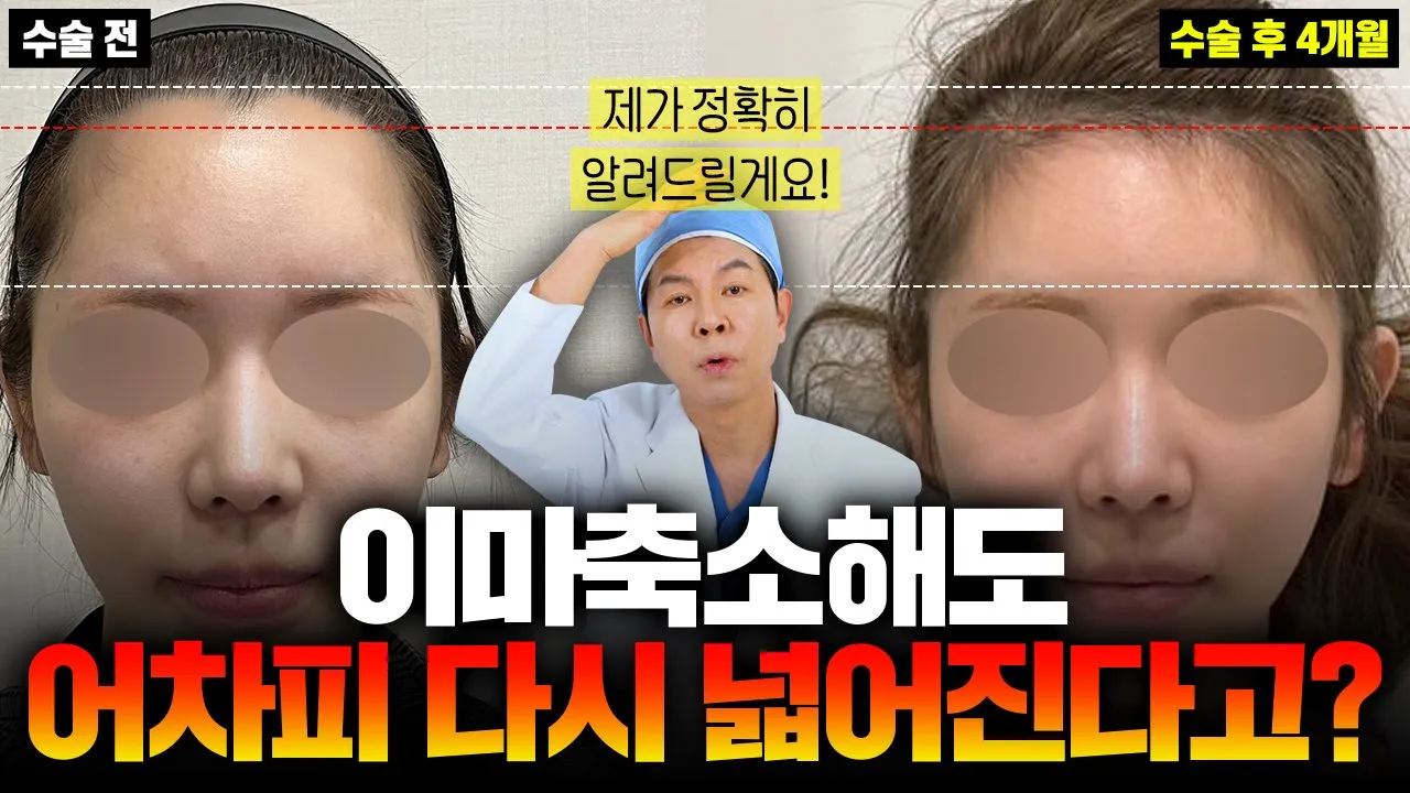 이마축소해도 어차피 넓어진다?|이마축소에 대해 알려드림🔥