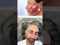 Do cancerous parotid tumors have any symptoms