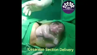 CESAREAN SECTION DELIVERY 