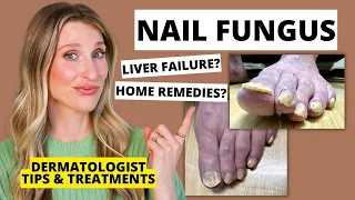 Dermatologist Shares Treatments for Nail Fungus Prevention Tips Dr Sam Ellis