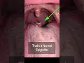Download Lagu ENT strange factoids. The “It is abnormal!” But is actually normal epiglottis #shorts @fauquierent