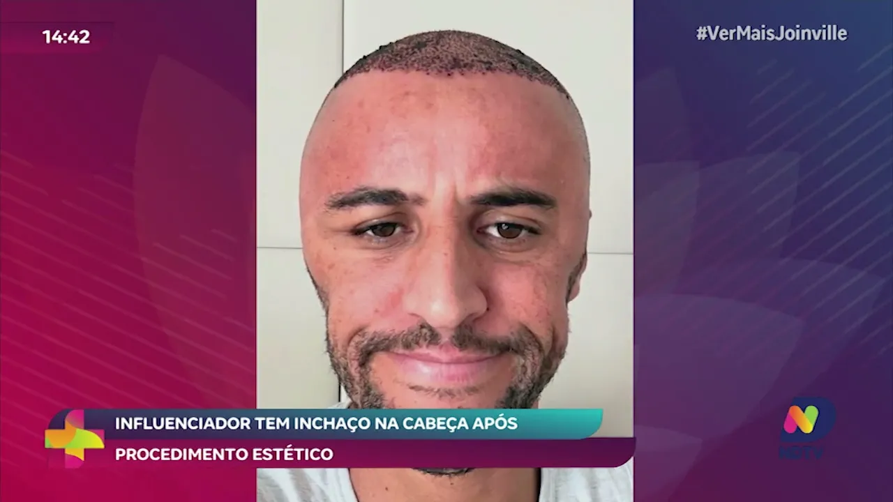 Influenciador tem inchaço na cabeça após procedimento estético