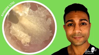 1,732 - Fungal-Coated Dead Skin Stripped from Ear Canal Using the iCLEARscope®