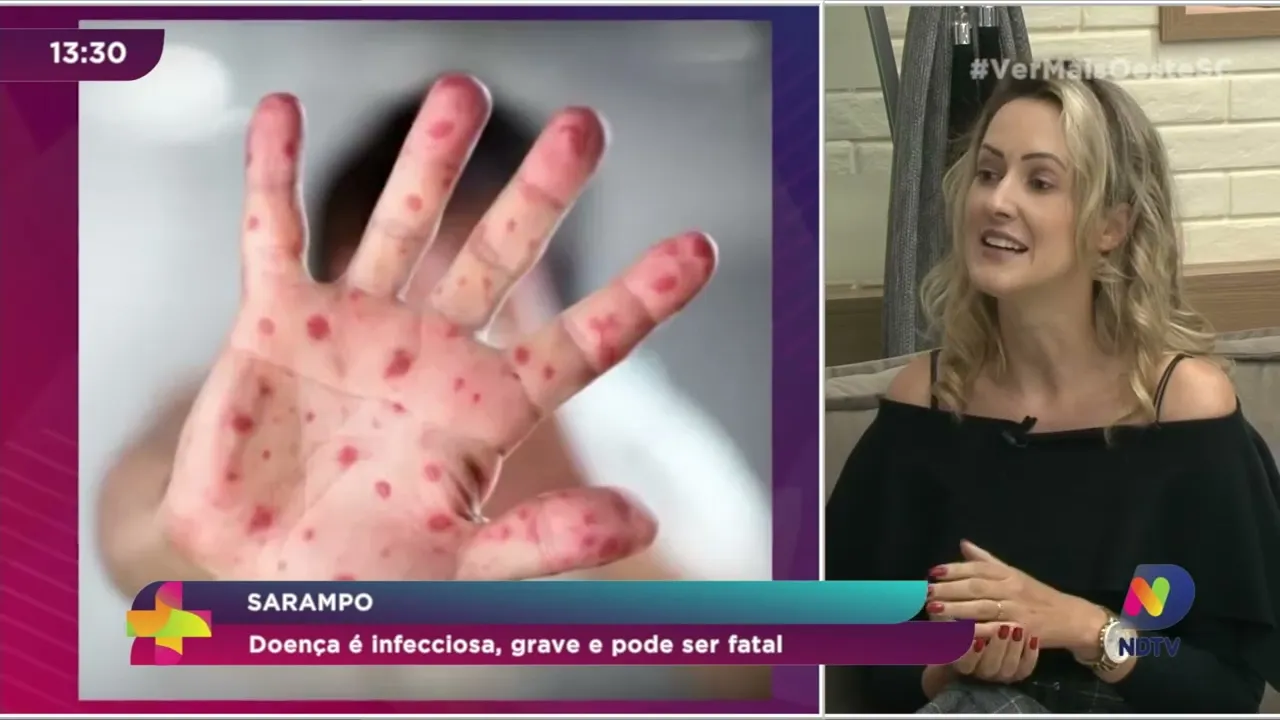 Sarampo: Doença é infecciosa, grave e pode ser fatal